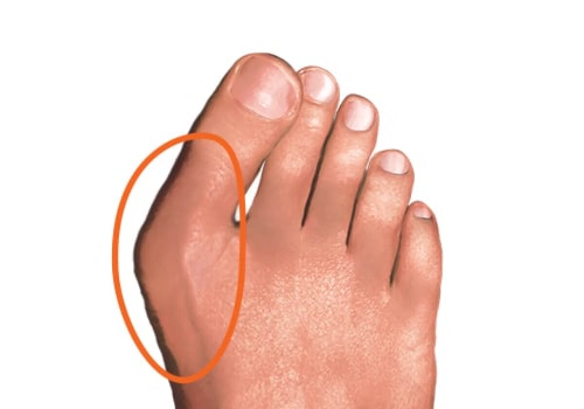 Immagine di un piede con alluce valgo.