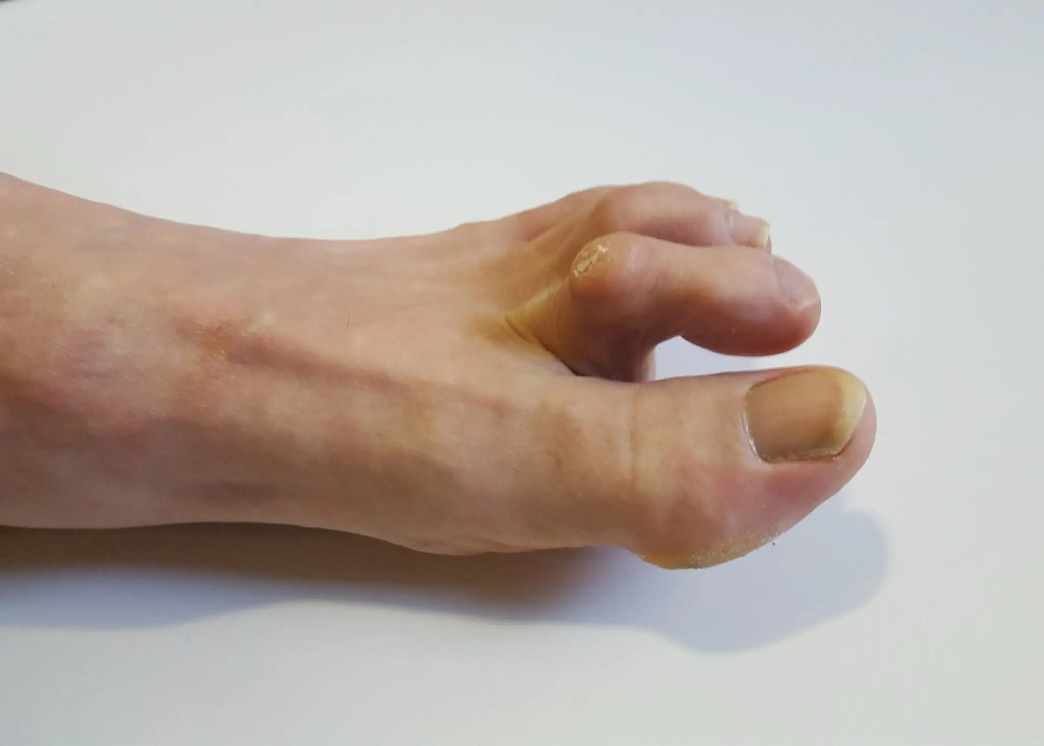 Piede con dita a martello.